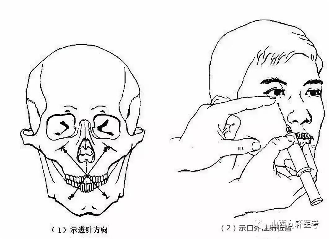 以麻醉腭前神经,又叫腭大孔注射法,图示同图—36(5)鼻腭神经阻滞麻醉