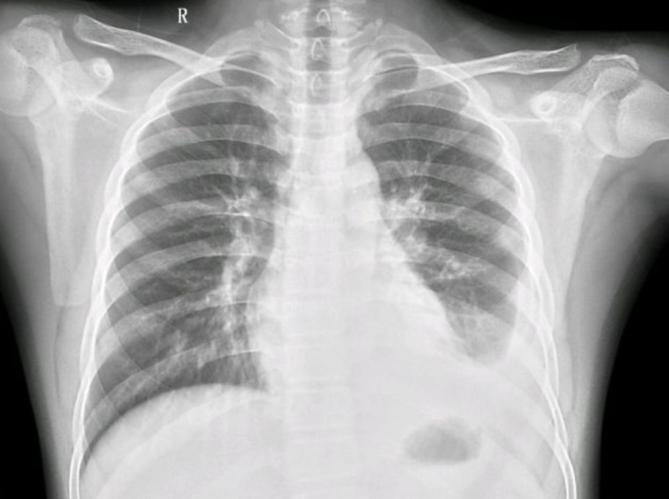 胸腔积液胸片图片