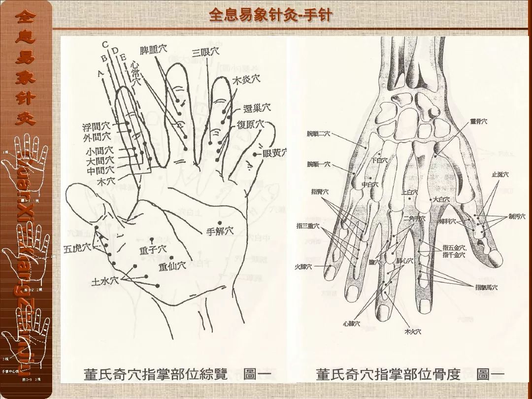 易针疗法示意图图片