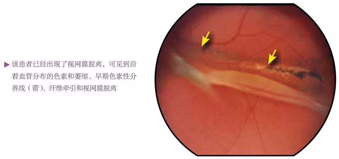 眼睛锯齿缘图片