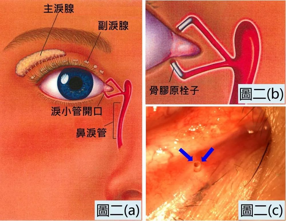 从眼球表面蒸发掉,余下的一半则会从上下两个泪小管开口经鼻泪管流走