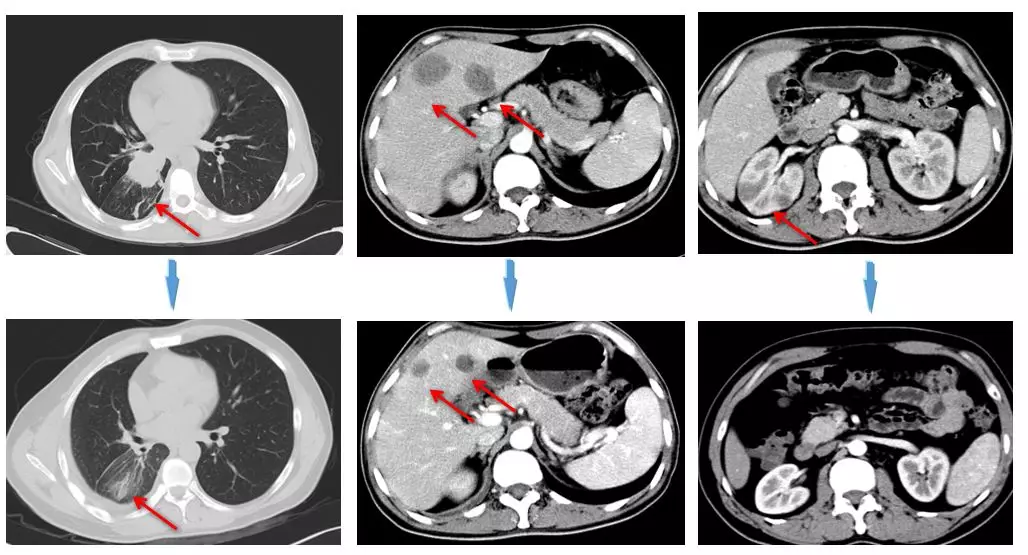 1,右下肺佔位灶,較前縮小; 2,肝臟多發佔位,較前減小;3,右腎上腺增粗