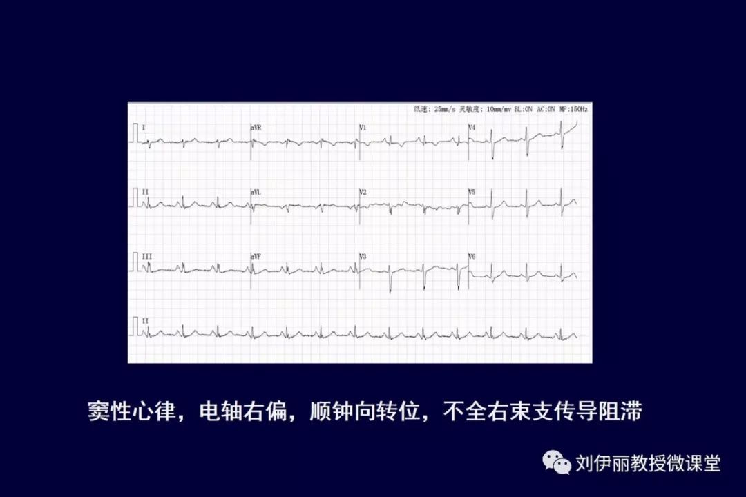 室壁瘤心电图表现图片