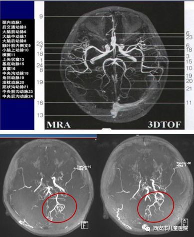 上图为磁共振血管成像中的正常大脑动脉环,下面两图为小丁(烟雾病)的