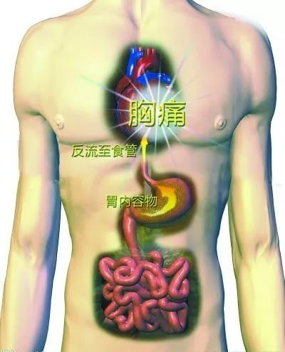 胃食管反流病的症状及治疗