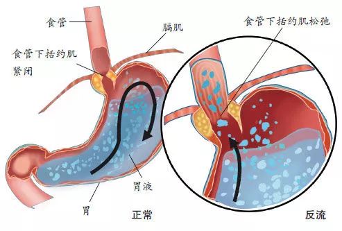 胃食管反流病的症狀及治療