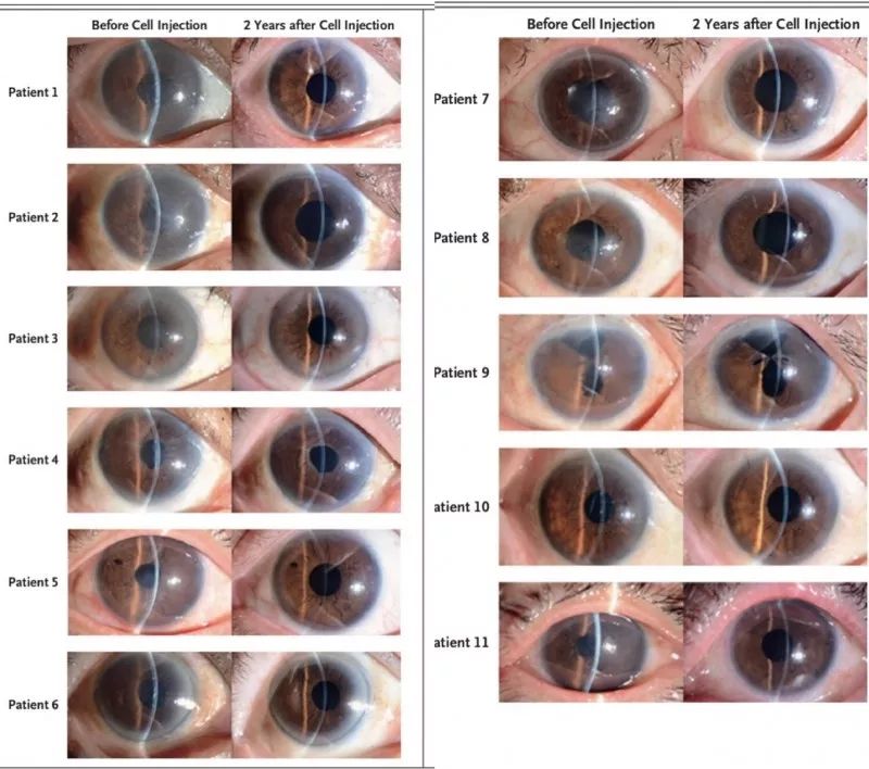 患眼治療及治療後2年的裂隙燈眼前節照相總結本研究為治療角膜內皮