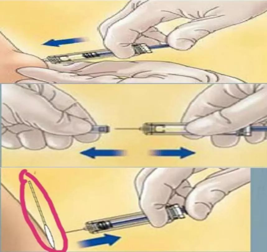 低分子上臂注射方法图图片