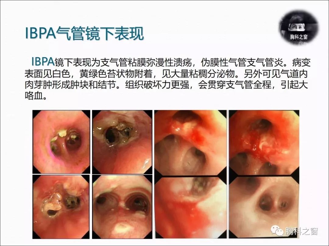 肺吸虫病的症状图片图片