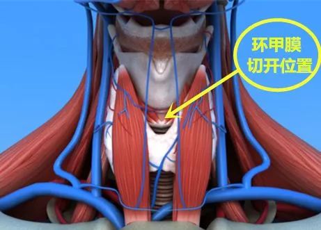环甲膜切开术位置图片