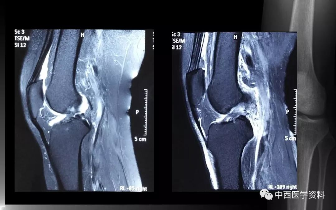 膝关节滑膜炎磁共振图片