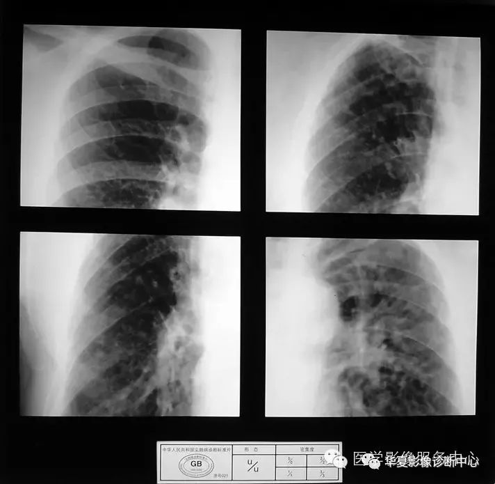 尘肺病标准图片 高清图片
