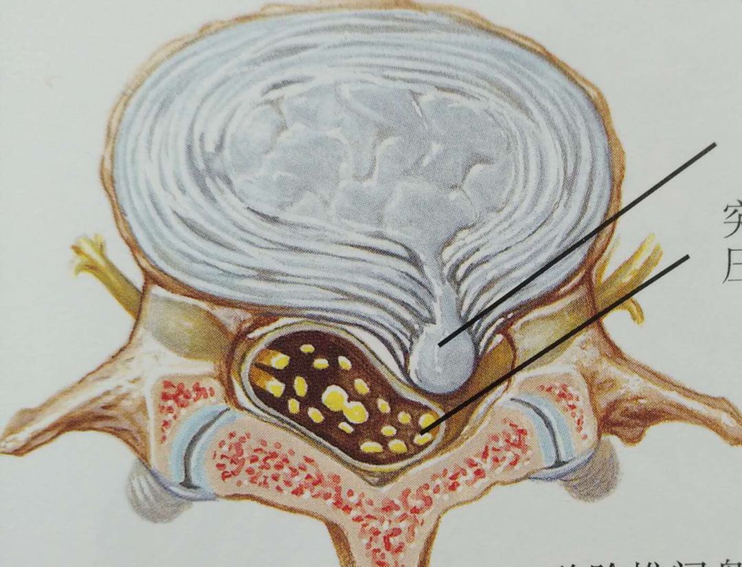 医学科普腰椎间盘突出症那些你必须知道的基本常识