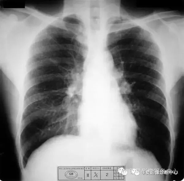 尘肺和正常肺ct图片图片
