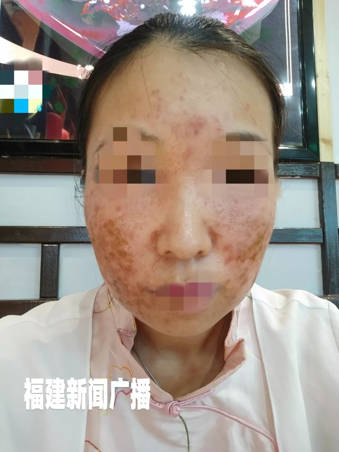 美容变毁容,福州一女子痛哭:连爹妈都快认不出她了