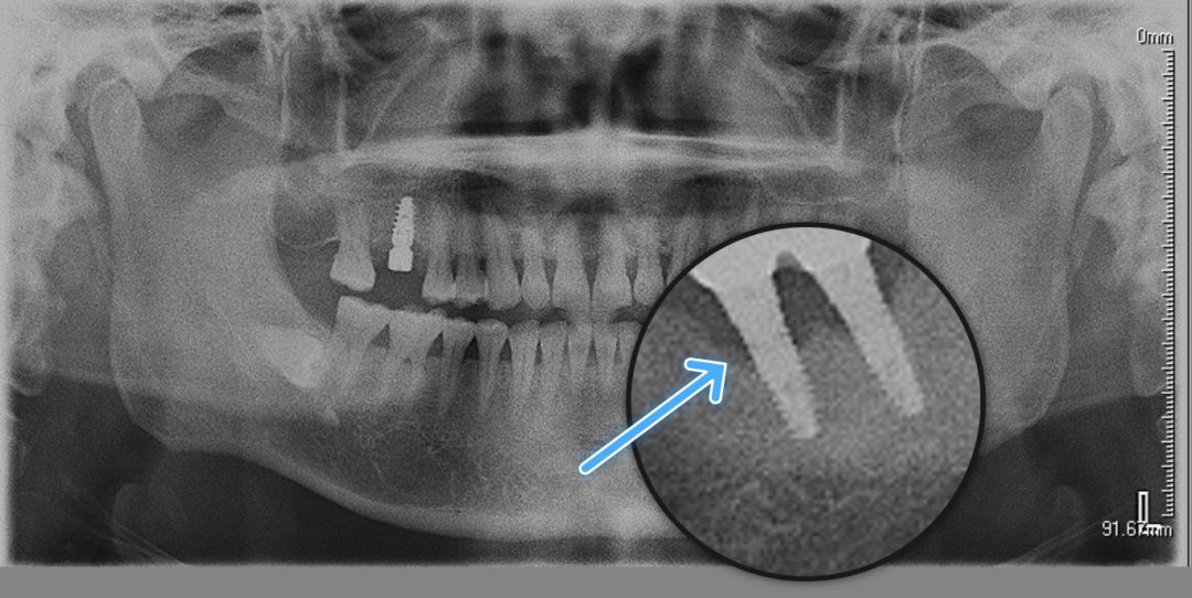 种植牙x片图片