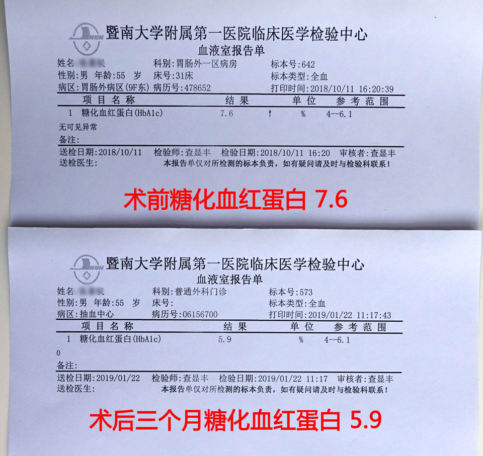 胃旁路术后三个月,糖化血红蛋白正常了!