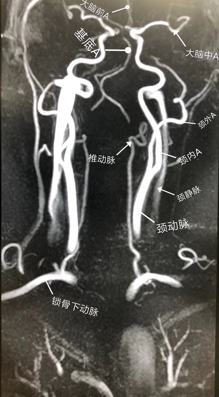 脑血管mra解剖图图片