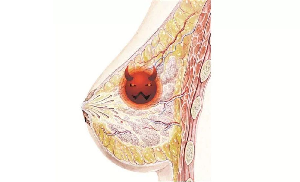 【佳美︱美胸汇】乳腺增生与乳腺结节的区别