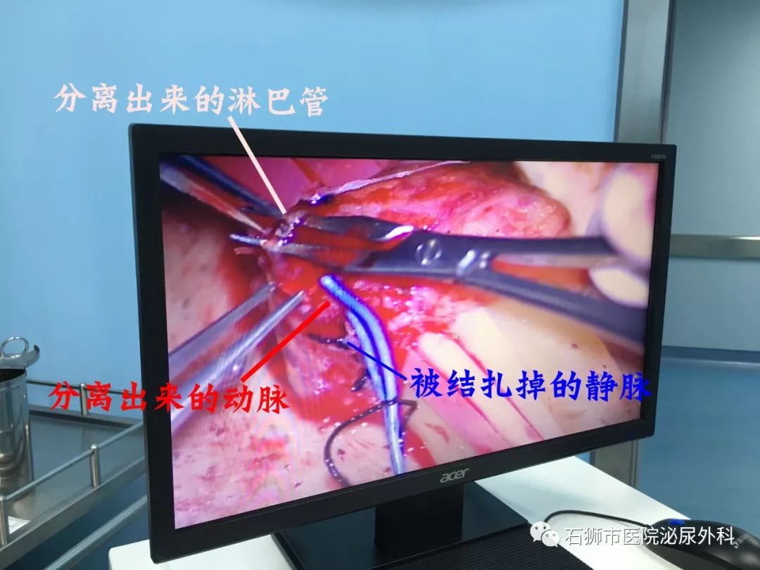 市总医院院成功开展首例显微镜下精索静脉曲张结扎 睾丸去神经术