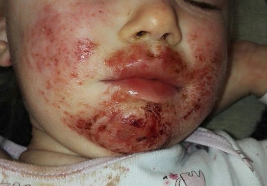 孩子完全无法进食只能靠营养液维持虽然现在孩子脸上的红疹已经不见了
