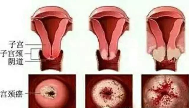 宫颈癌变图真实图图片