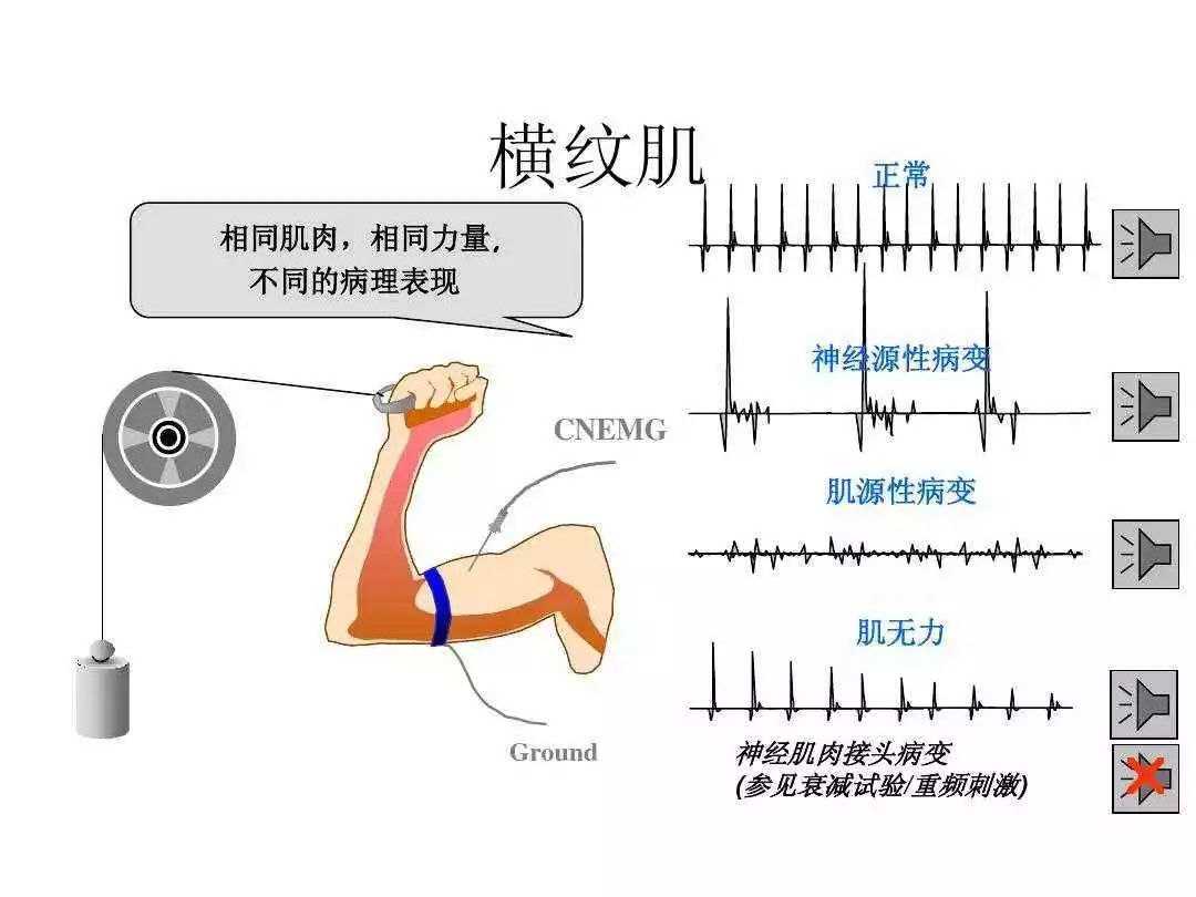 面神经肌电图图解图片