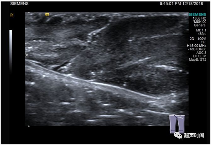 皮下纤维瘤超声声像图图片