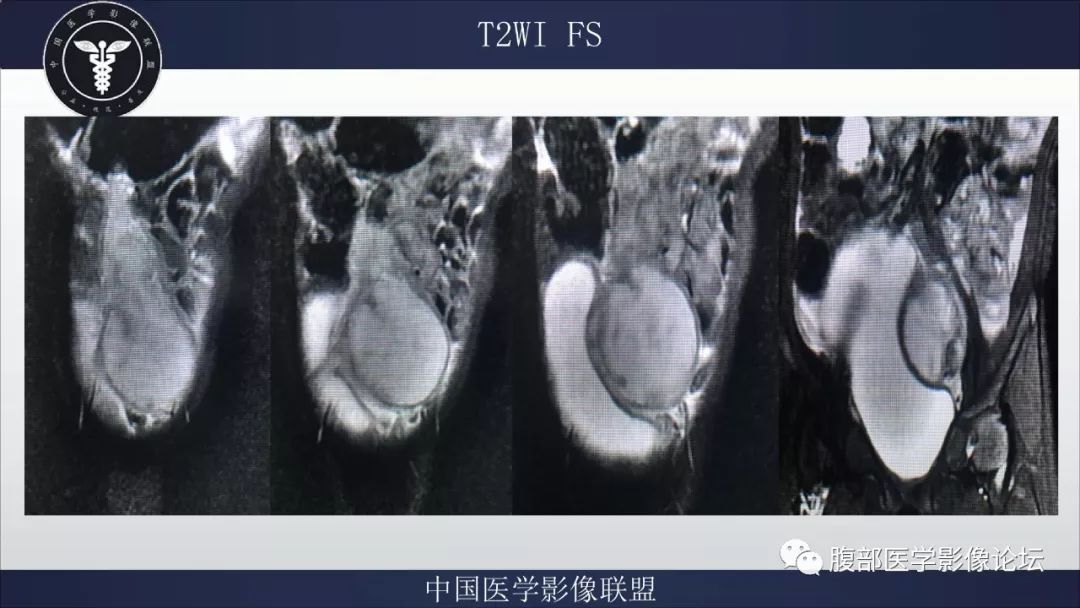 女性脐尿管囊肿手术图片