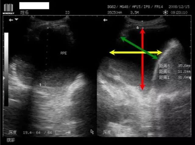 腹水的超声测量图解图片