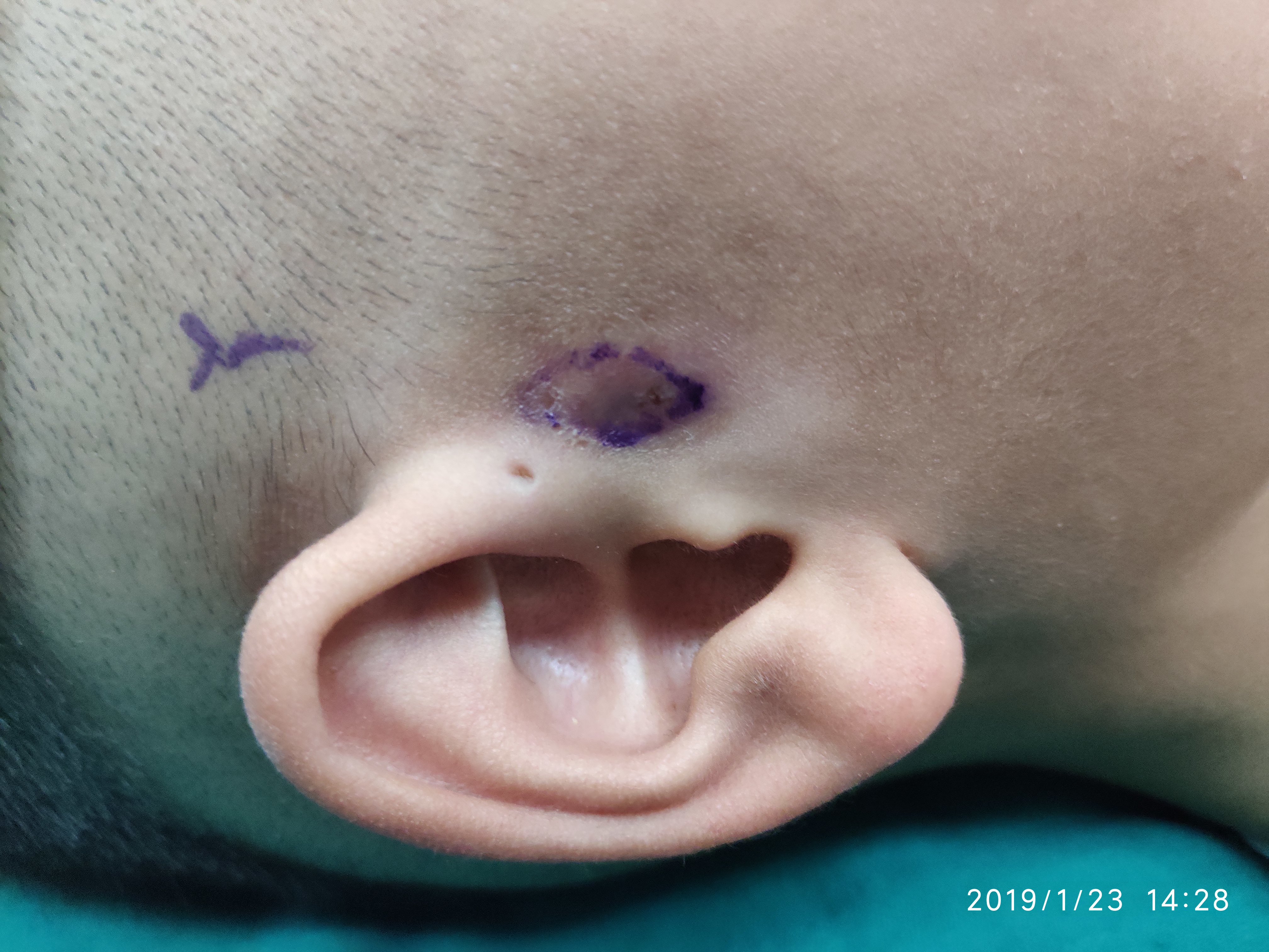 儿童耳瘘手术后图片图片
