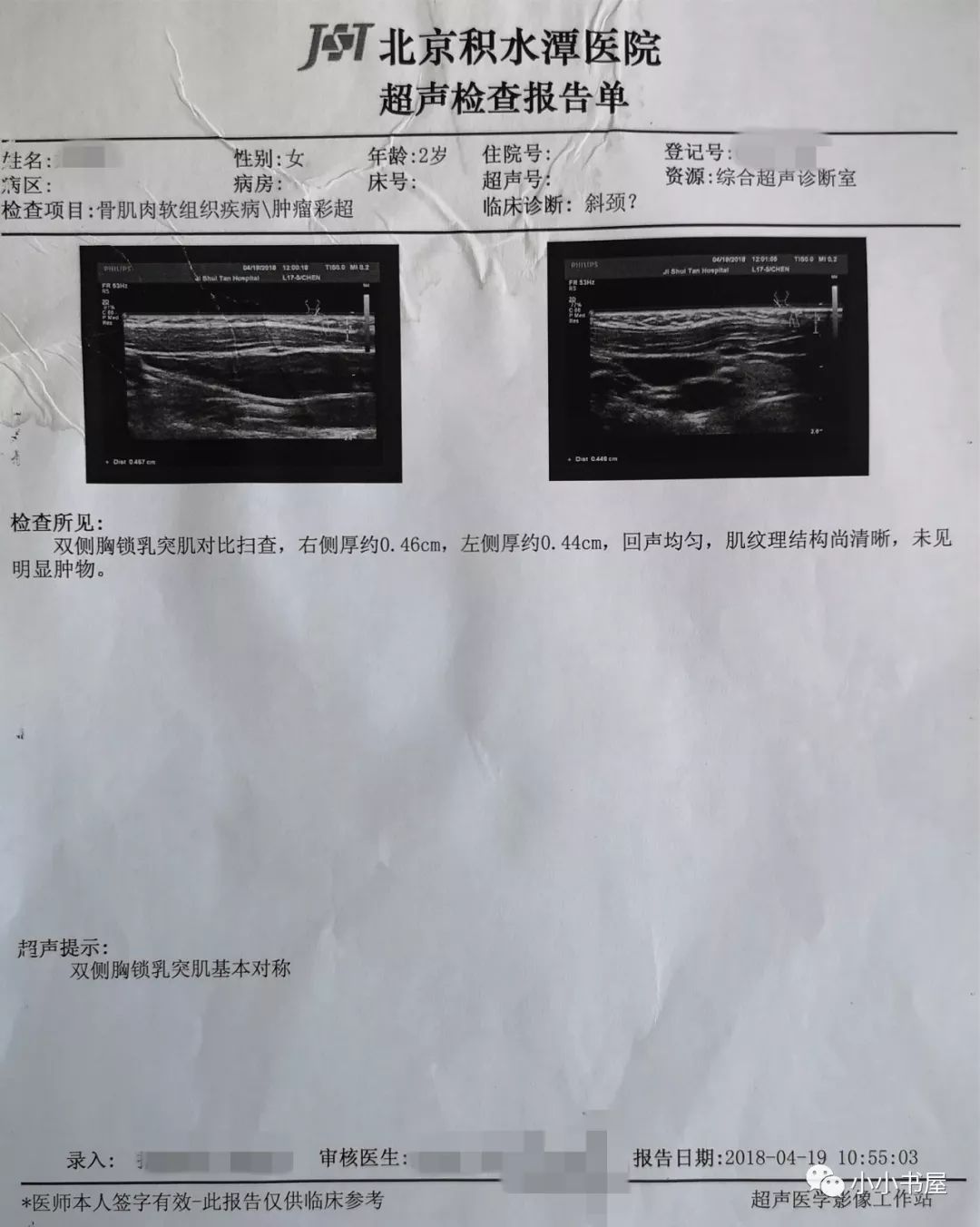 病例肌性斜颈不是胸锁的专利