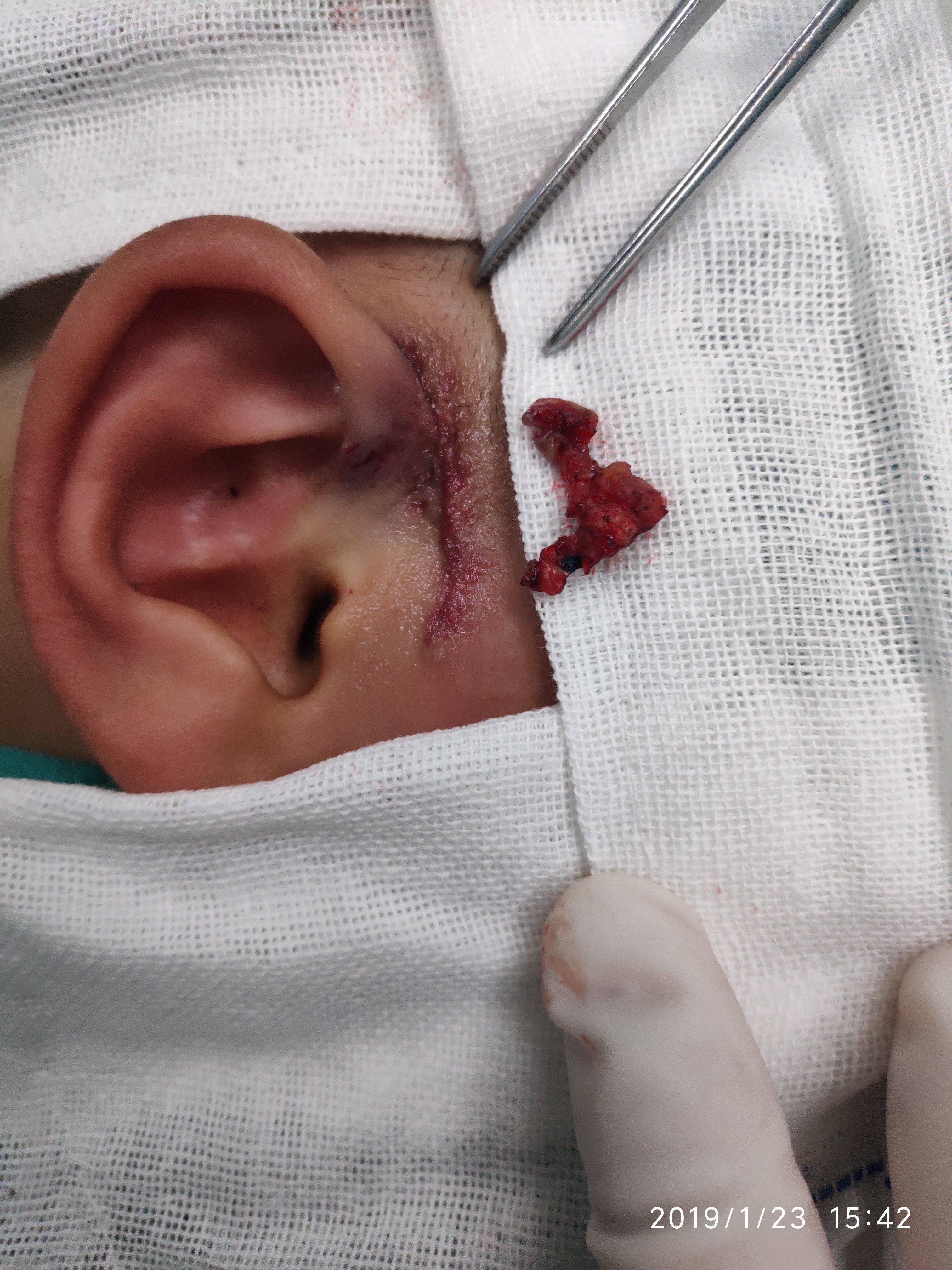 耳前瘘管手术过程图片