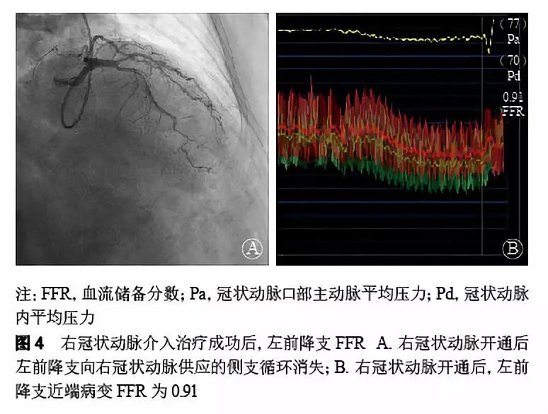 上海瑞金醫院對側支供血動脈的臨界狹窄病變行pci前可先進行cto血運