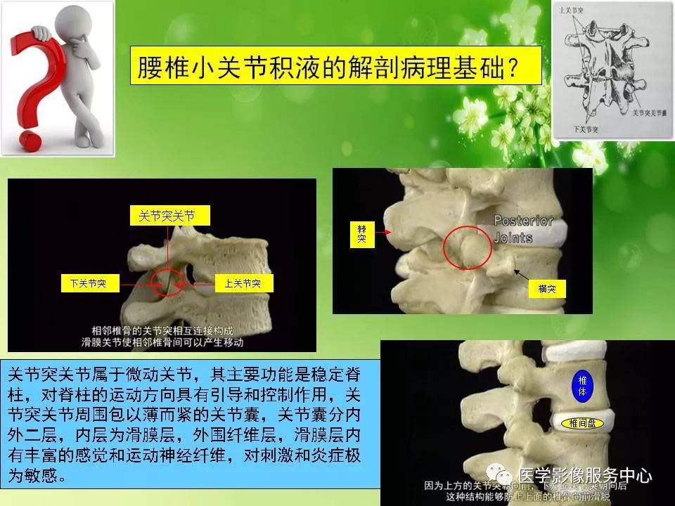 腰椎小關節滑囊積液一個易被忽略的病變