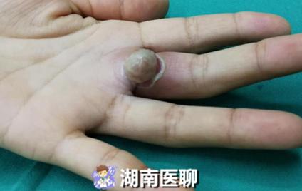 28岁女子血管瘤切除后又复发手指上长肿物比花生大