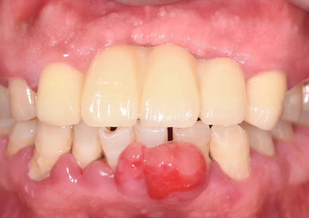 该患者因牙龈瘤反复出现做过4次牙龈瘤切除手术,并拔出了上前牙,每次