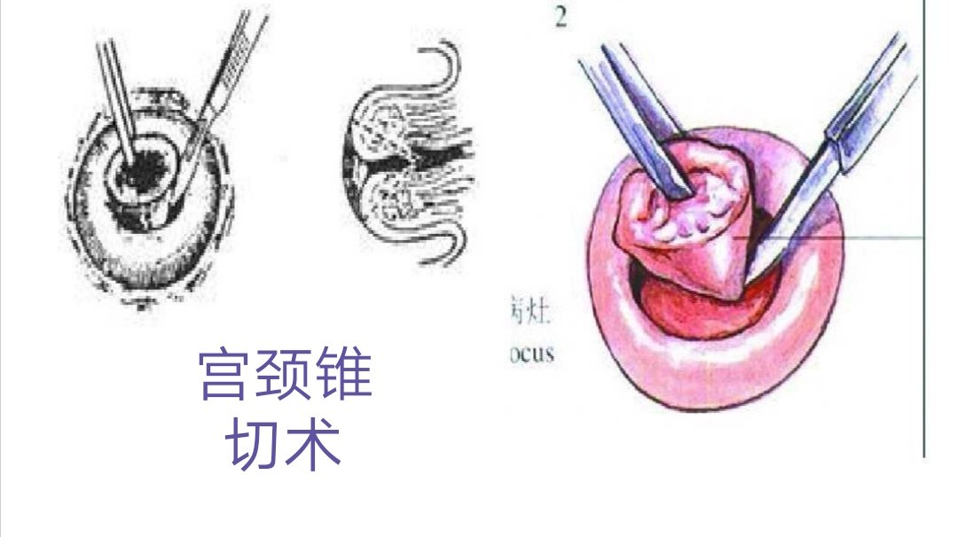 宫颈部分切除术图片图片