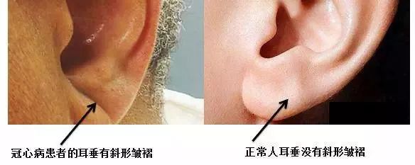 通过耳朵来判断有无冠心病我想说