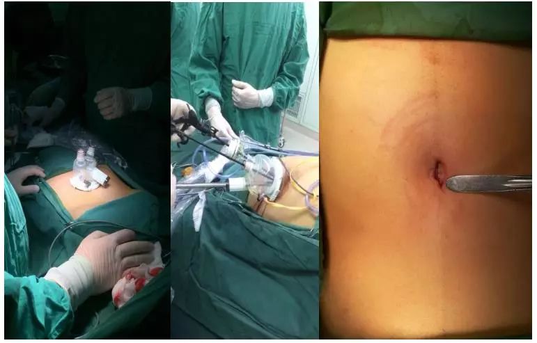 微创胆结石手术过程图片