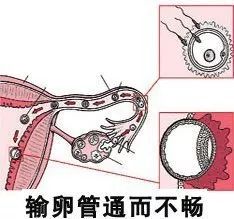 【孕育科普】輸卵管通而不暢想懷孕怎麼辦?