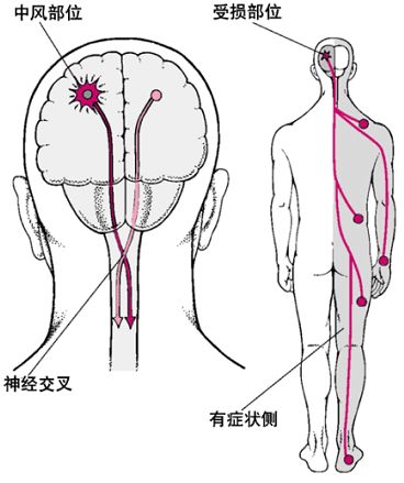 偏瘫的中医康复疗法