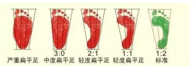 及時發現孩子足部異常 日常生活中,如何儘早發現孩子有扁平足的情況呢