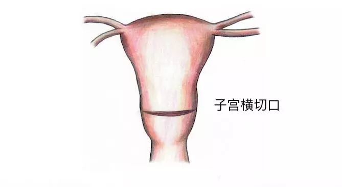 宫腔下段位置图片图片