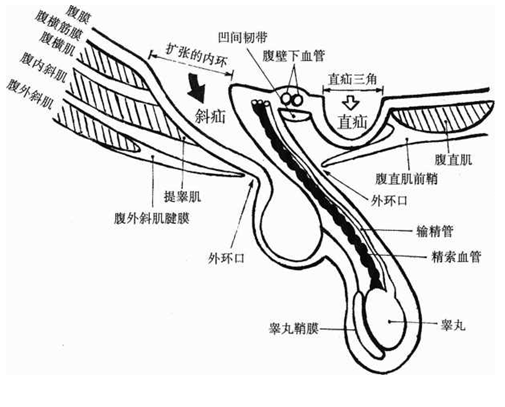 斜疝解剖图图片