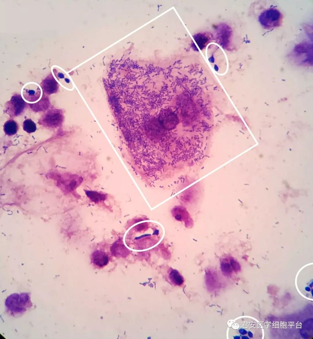 加德纳菌阳性白带图片图片