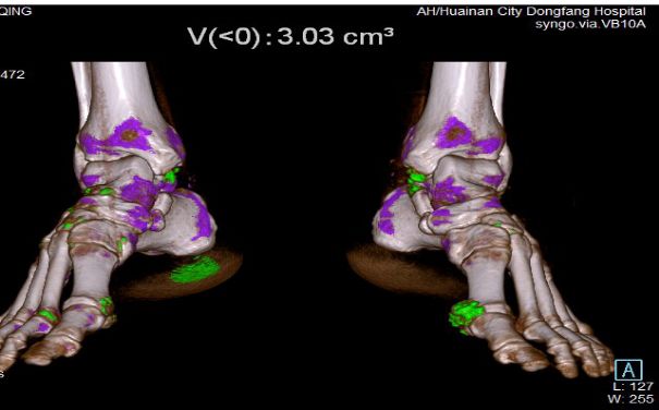 双源ct痛风图片