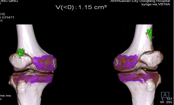 双源ct痛风图片