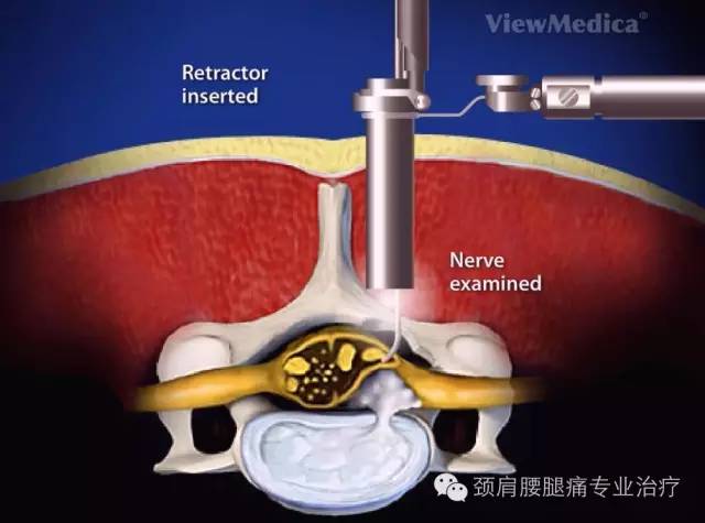 中英文字幕:颈椎med(micro endoscopic posterior cervical
