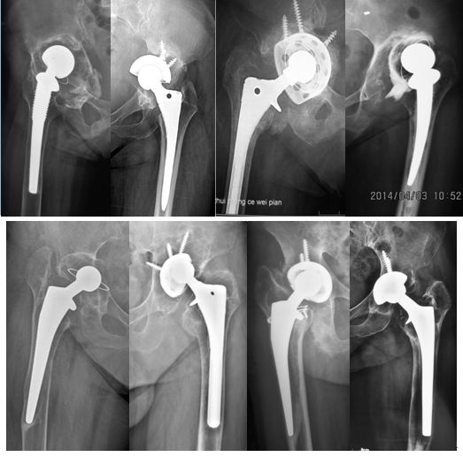 刘欢讲人工髋关节置换图片